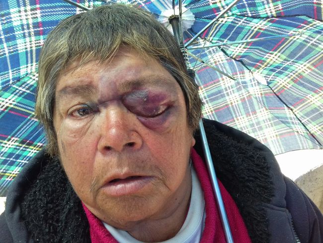 Así quedó con el golpe el rostro de la comerciante Ulda Araya Toro.