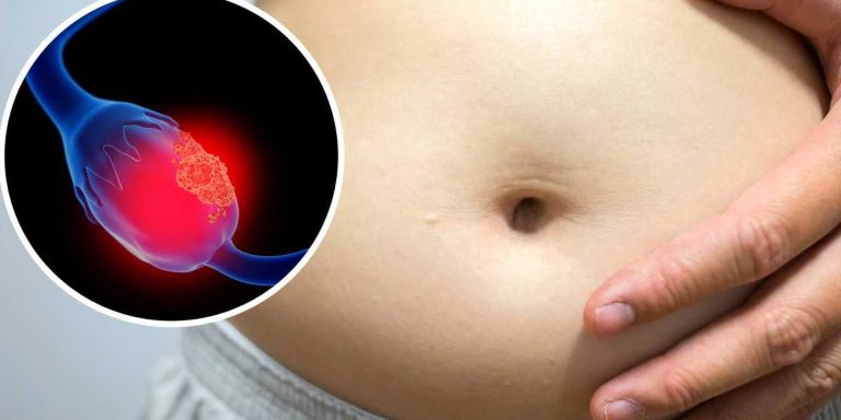Cáncer de ovario: Ninguna mujer se queda atrás